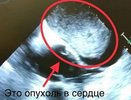 В Челнах врачи удалили 10-сантиметровую опухоль из сердца