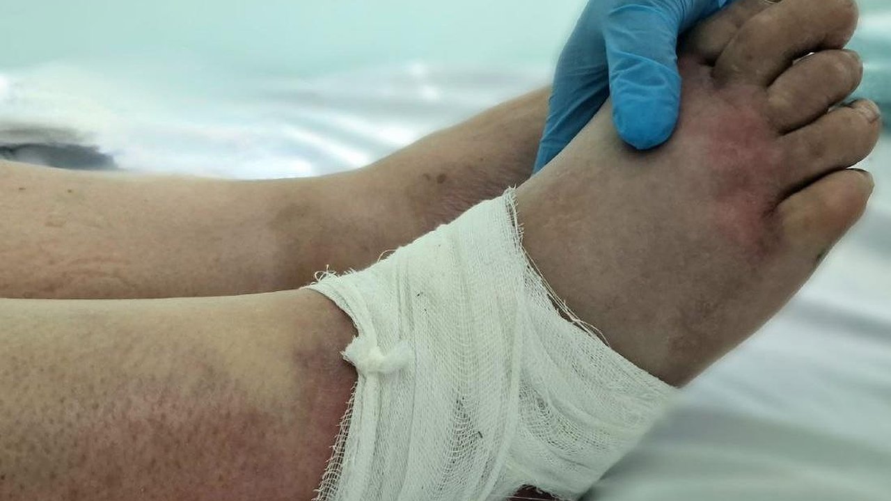 Главная картинка новости: В больницу Челнов поступили пять пациентов с укусами гадюк