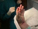 Челнинец избежал ампутации пальца благодаря мастерству врачей БСМП