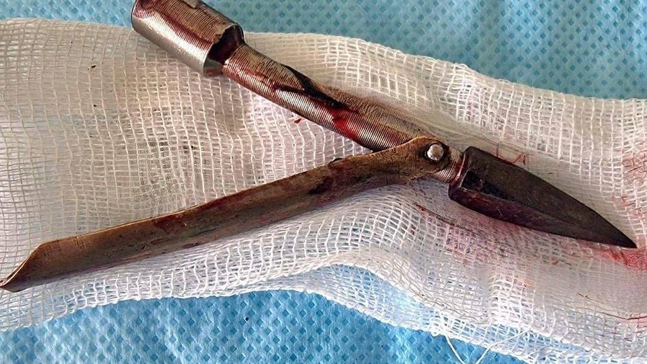 Главная картинка новости: У жителя Челнов извлекли из головы наконечник гарпуна