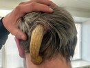 Жителю Челнов удалили огромный рог, выросший на затылке (фото)