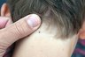 Миниатюра новости: Первый случай этой весной укуса клеща в Челнах