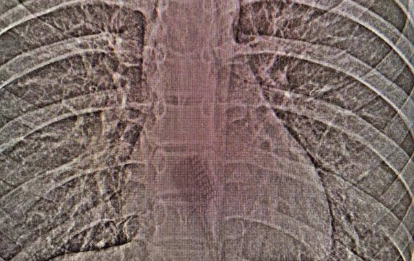 Врачи достали из желудка 13-летней челнинки 19-сантиметровую зубную щетку