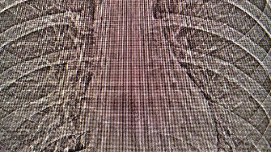 Главная картинка новости: Врачи достали из желудка 13-летней челнинки 19-сантиметровую зубную щетку