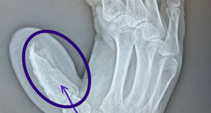 В РКБ Татарстана микрохирурги вырастили челнинцу новый палец