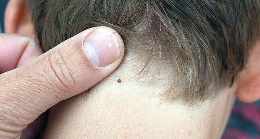 Первый случай этой весной укуса клеща в Челнах