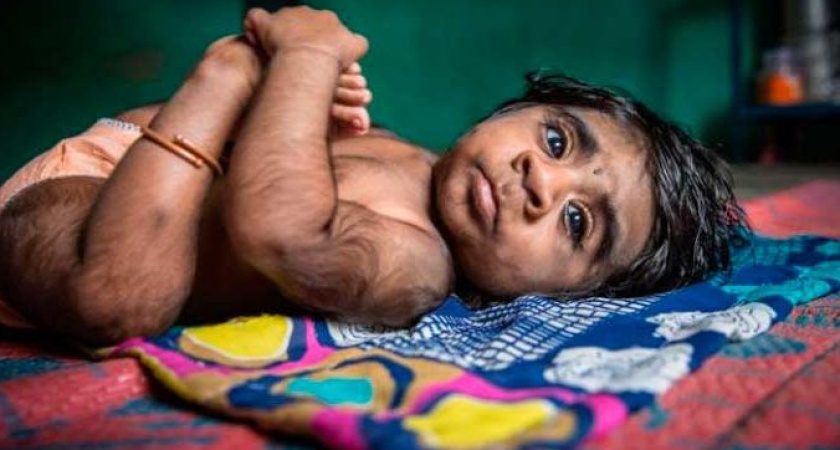 У 16 детей в Испании нашли синдром оборотня