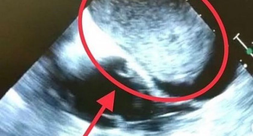 В Челнах врачи удалили 10-сантиметровую опухоль из сердца