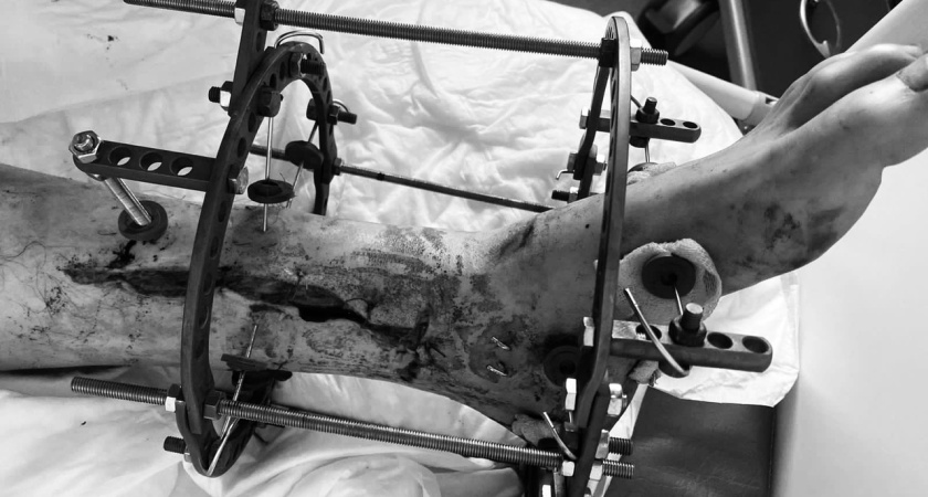 Чудо хирургии: врачи БСМП спасли от ампутации стопу