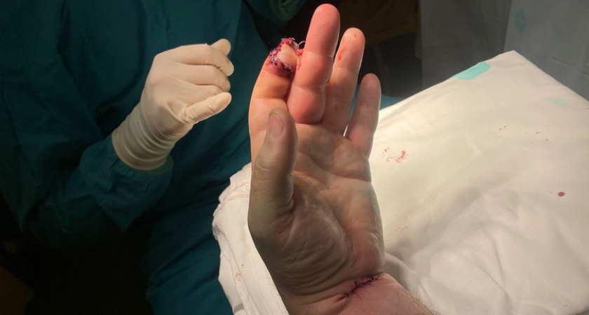 Челнинец избежал ампутации пальца благодаря мастерству врачей БСМП