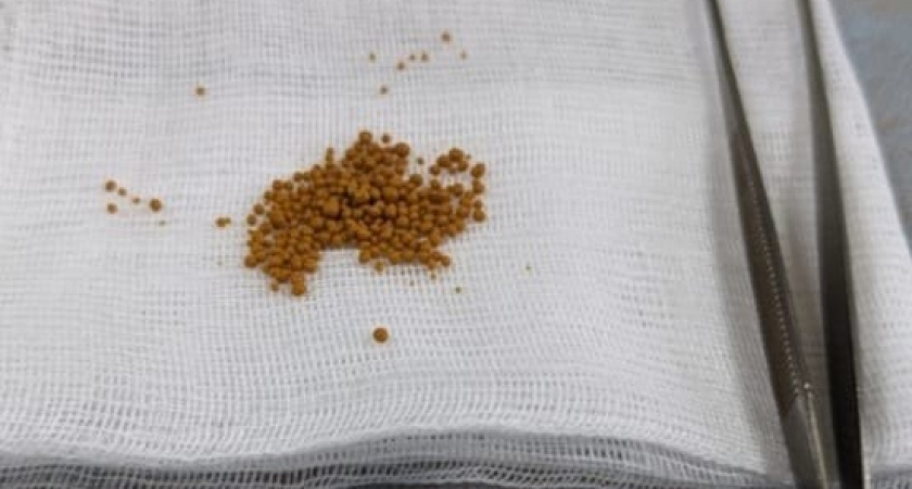 Жителю Челнов удалили 150 камней и огромную опухоль