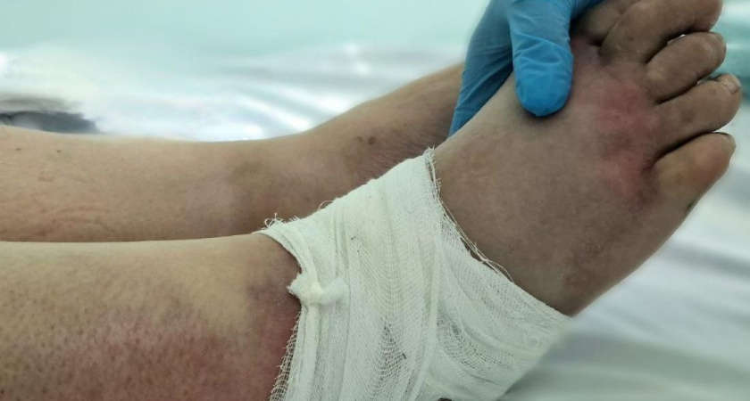 В больницу Челнов поступили пять пациентов с укусами гадюк