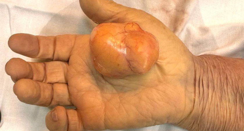 В БСМП Челнов пенсионерке удалили гигантскую опухоль – она росла на руке женщины 13 лет