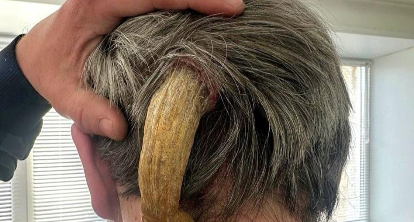 Жителю Челнов удалили огромный рог, выросший на затылке (фото)