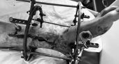 Чудо хирургии: врачи БСМП спасли от ампутации стопу