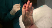 Челнинец избежал ампутации пальца благодаря мастерству врачей БСМП