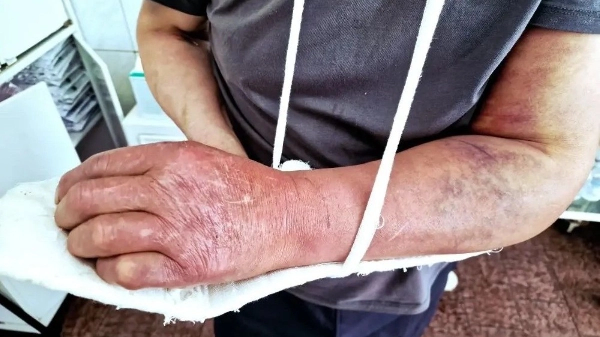 Челнинские врачи спасли мужчину с отеком Квинке, которого укусила ядовитая змея